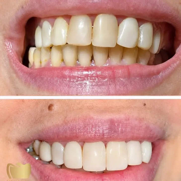 Carilla dental en resina