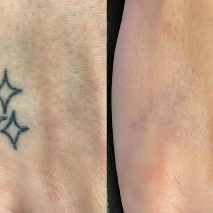Remocion de tatuajes >