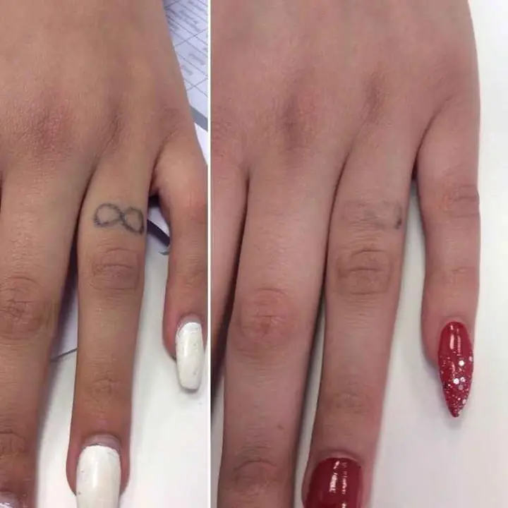 Eliminación de tattoo