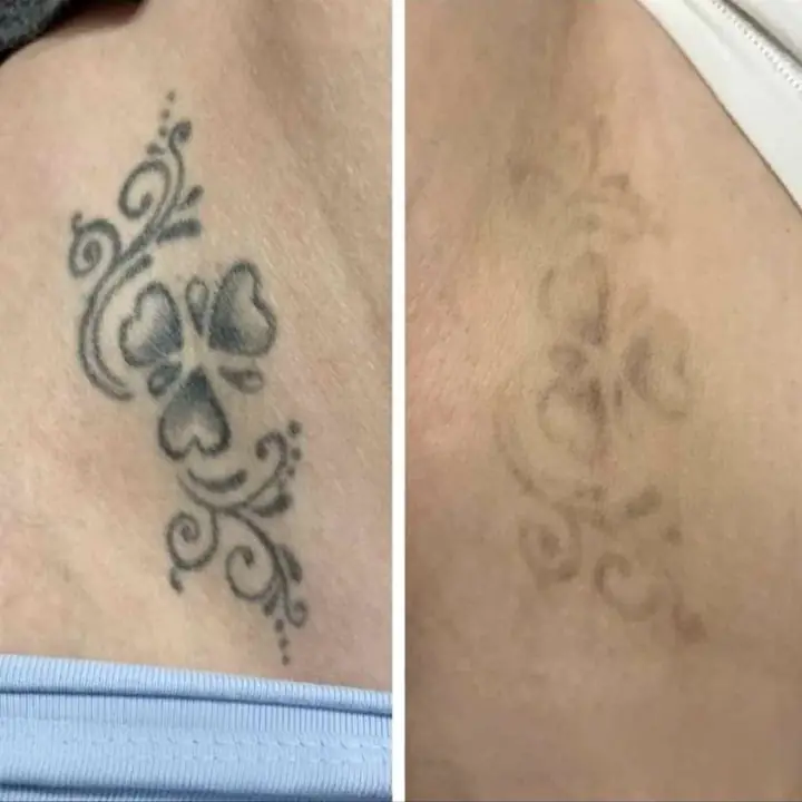 Eliminación de tatuajes /<>