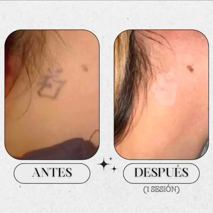 Borrando tattoos