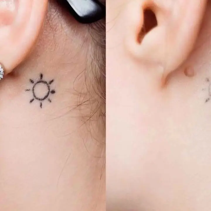 Remocion/ de tatuajes////