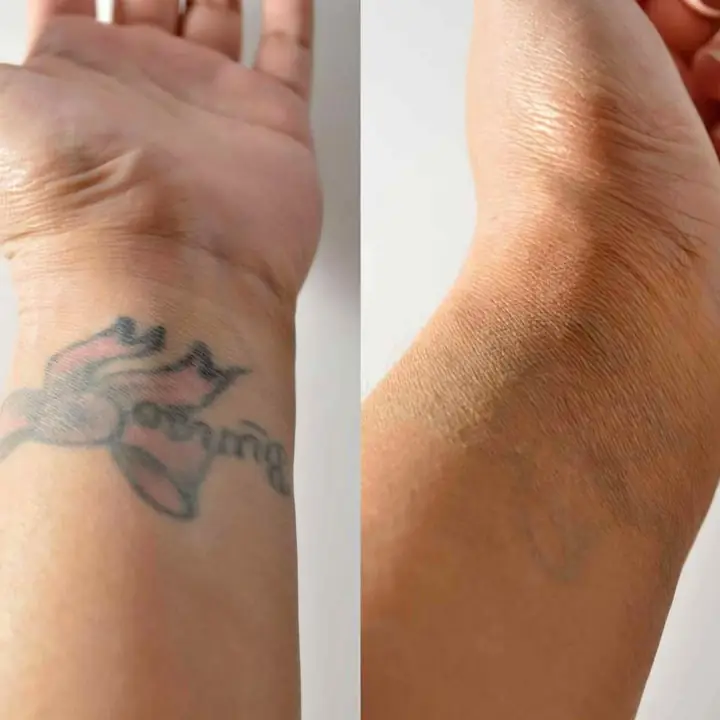 Remocion de tatuajes //