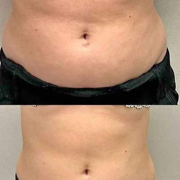 Tratamiento con naderoterapia reduccion