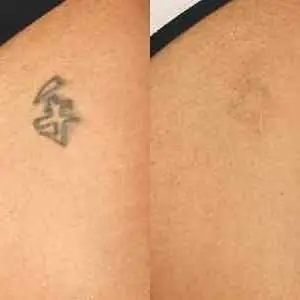 Eliminación de tatuajes