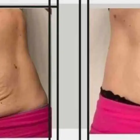 Fibroplast