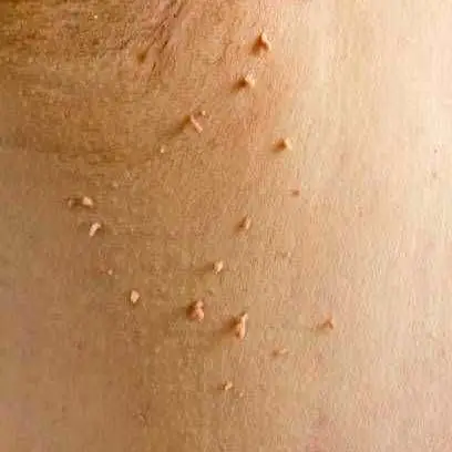 Remoción de acrocordones