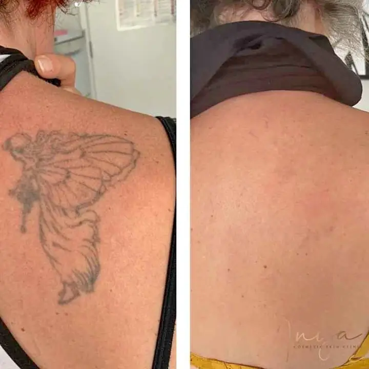 Extracción de tatuajes -///
