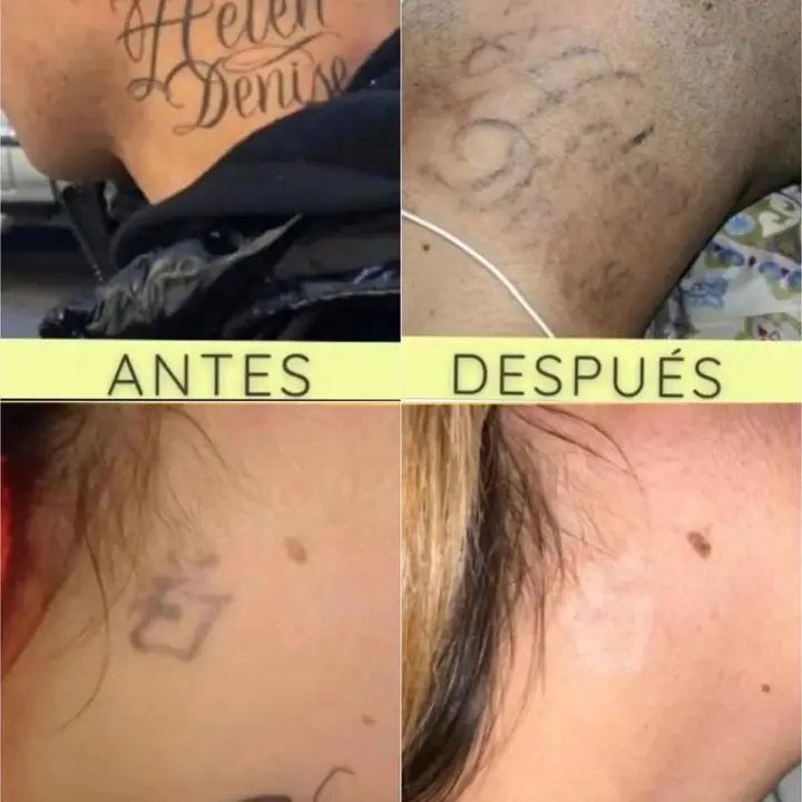 Remocion tatuajes