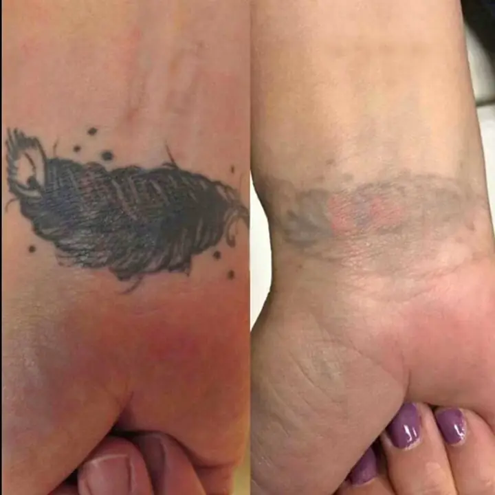 Remocion de tatuajes >