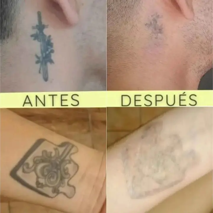 Extracción tatuajes