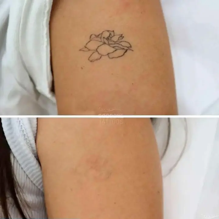 Remover tus tattoos