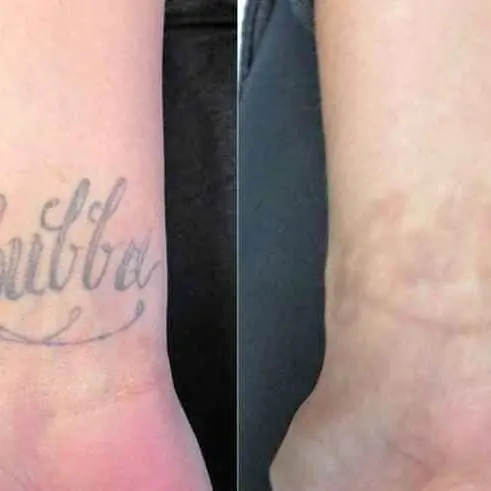 Remocion de tatuajes -/