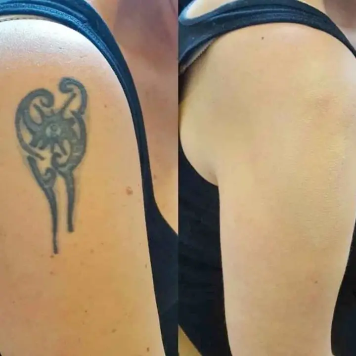 Remocion de tatuajes