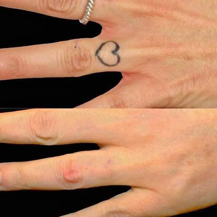 Remocion de tatuajes ^