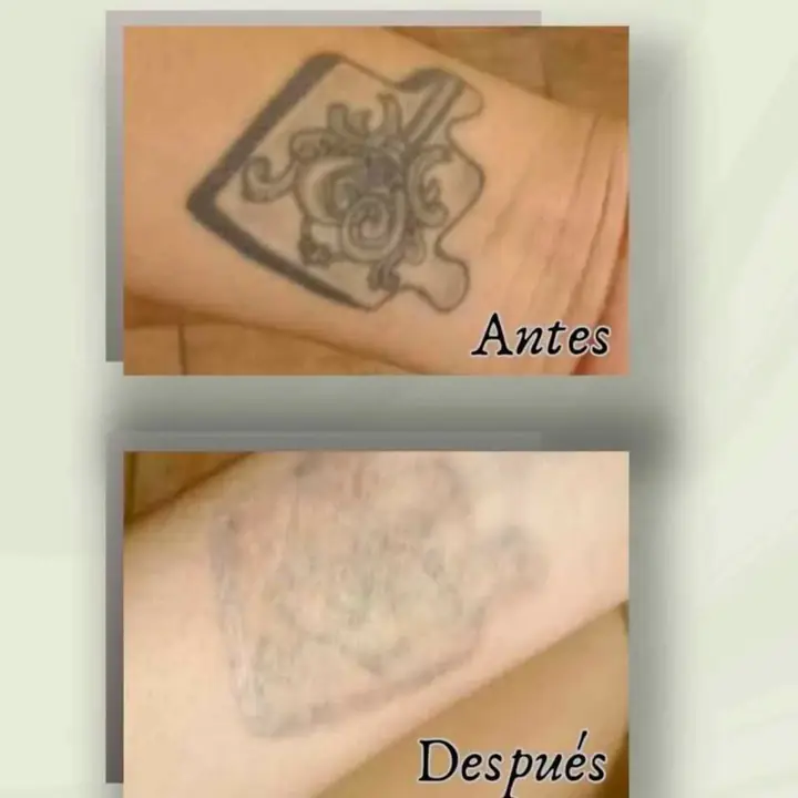 Borrar tattoo