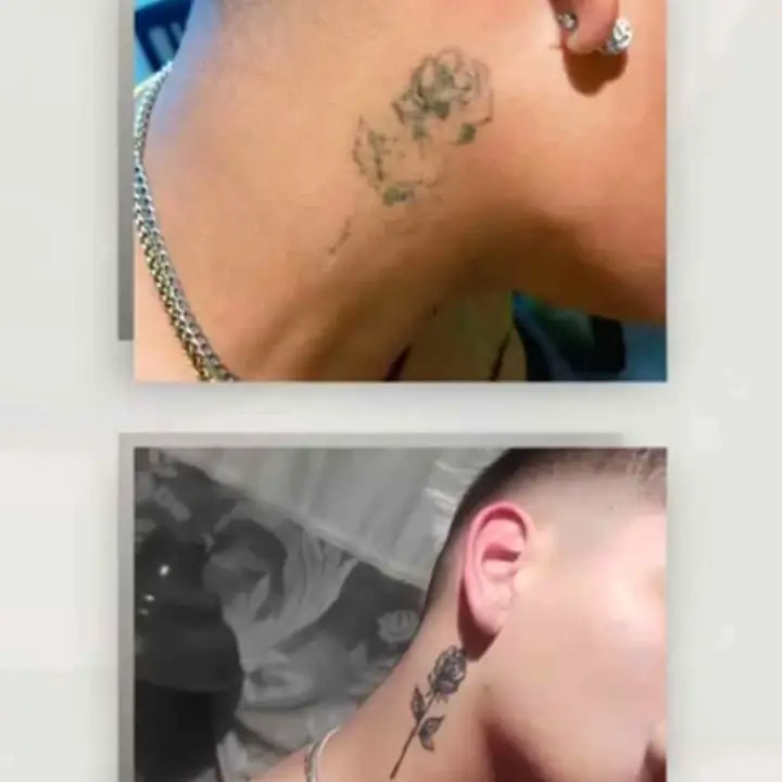 Borrar tatuajes