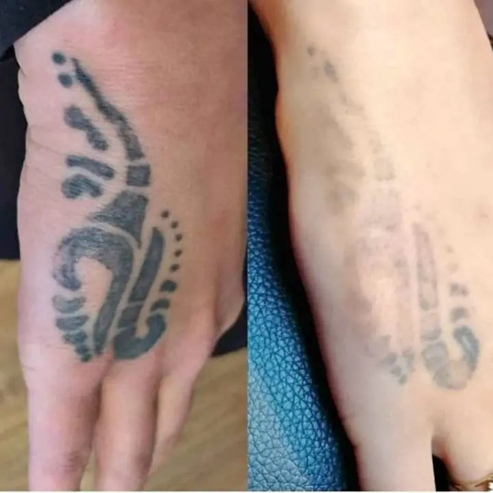 Remocion de tatuajes <