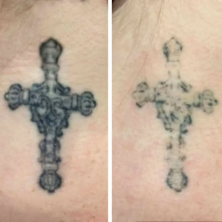 Remocion de tatuajes ^