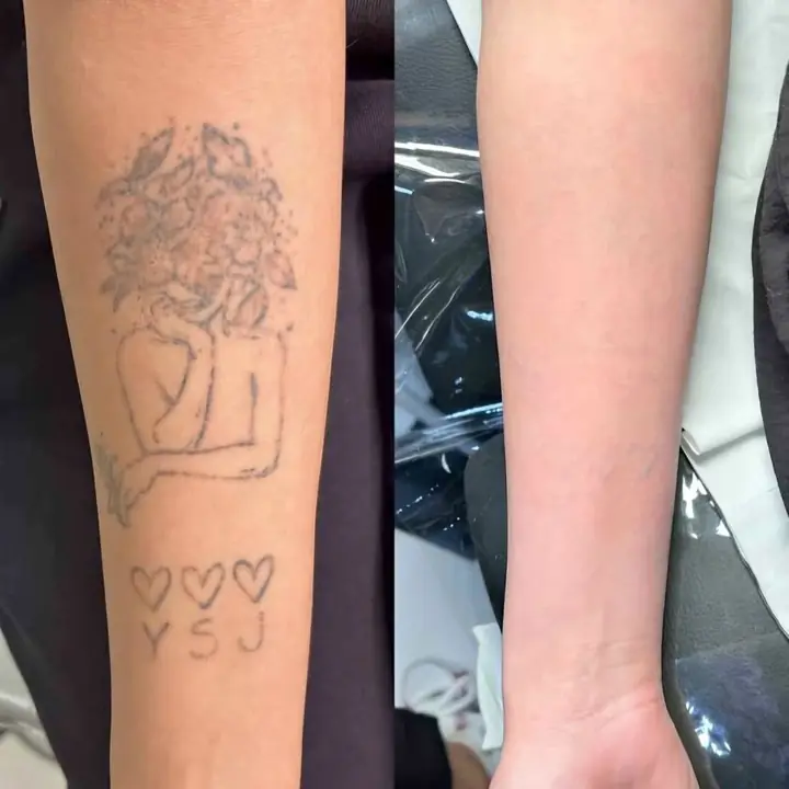 Remocion de tatuajes ///