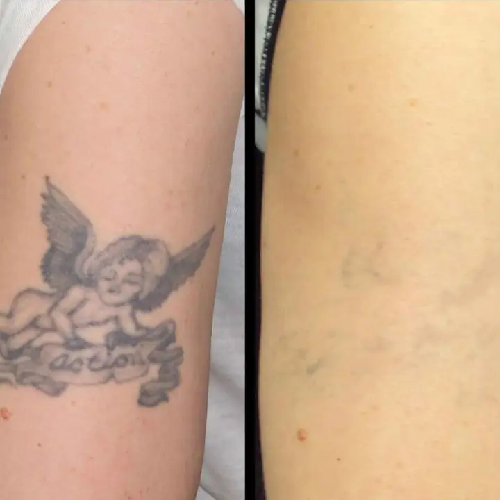 Remocion de tatuajes