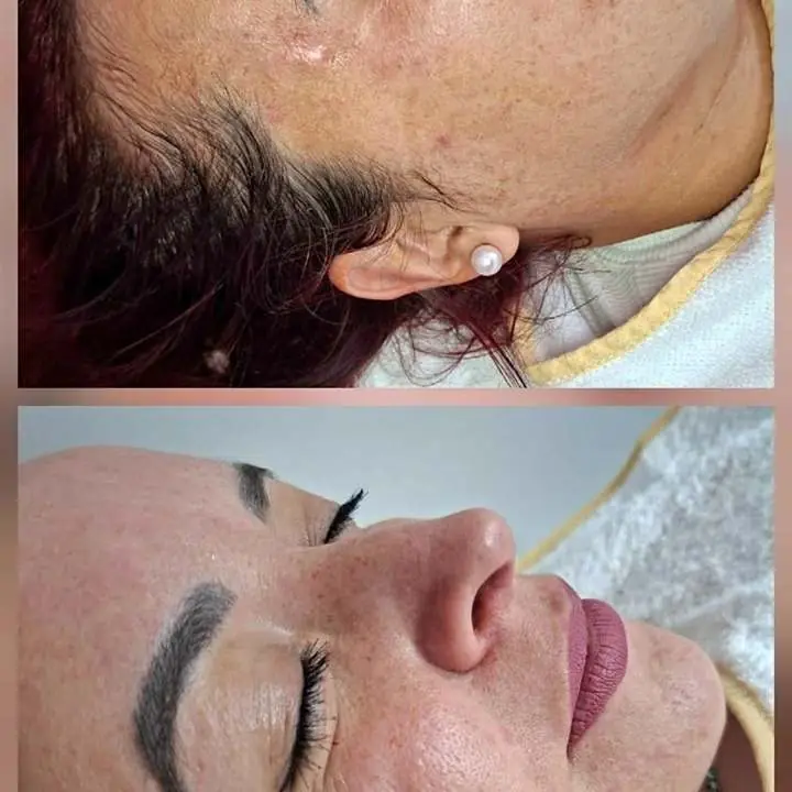 Rejuvenecimiento facial prp