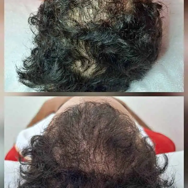 Prp capilar ¿Notas caída del cabello o pérdida de volumen