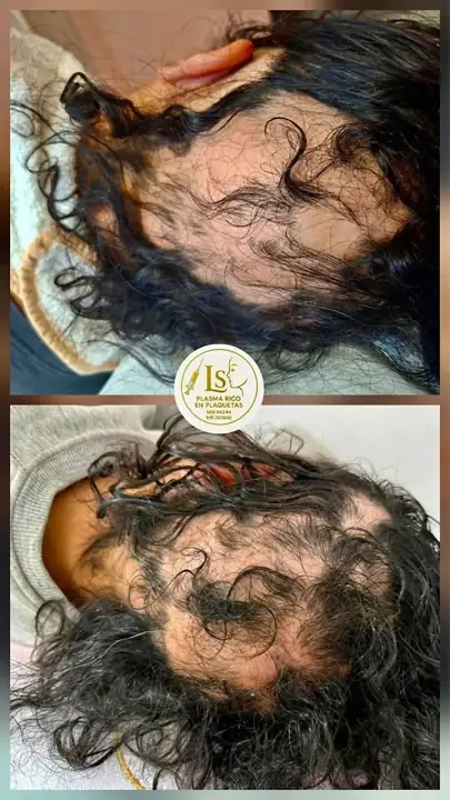 Caída del cabello