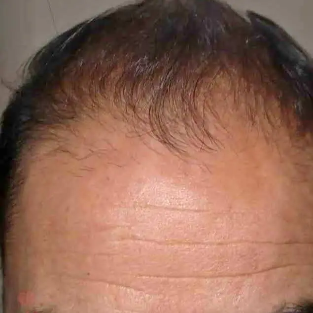 Caída del pelo