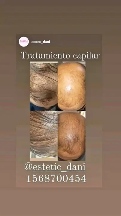 Alopecia, calvicie ,tratamiento capilar caída capilar