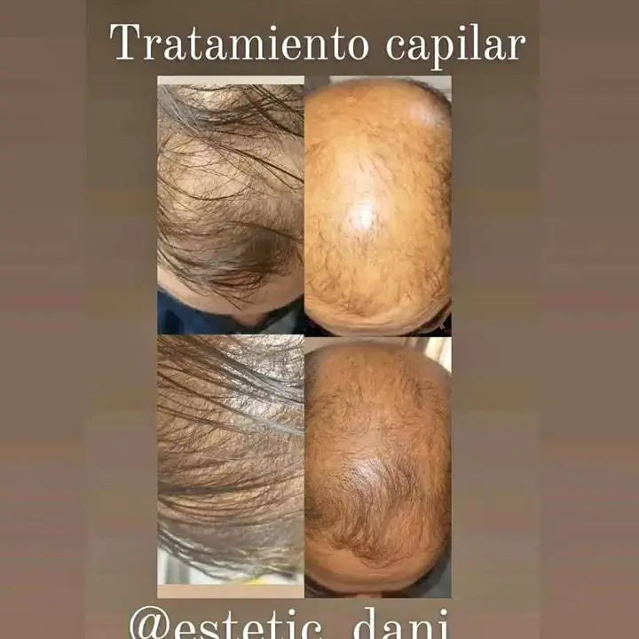 Alopecia, calvicie ,tratamiento capilar