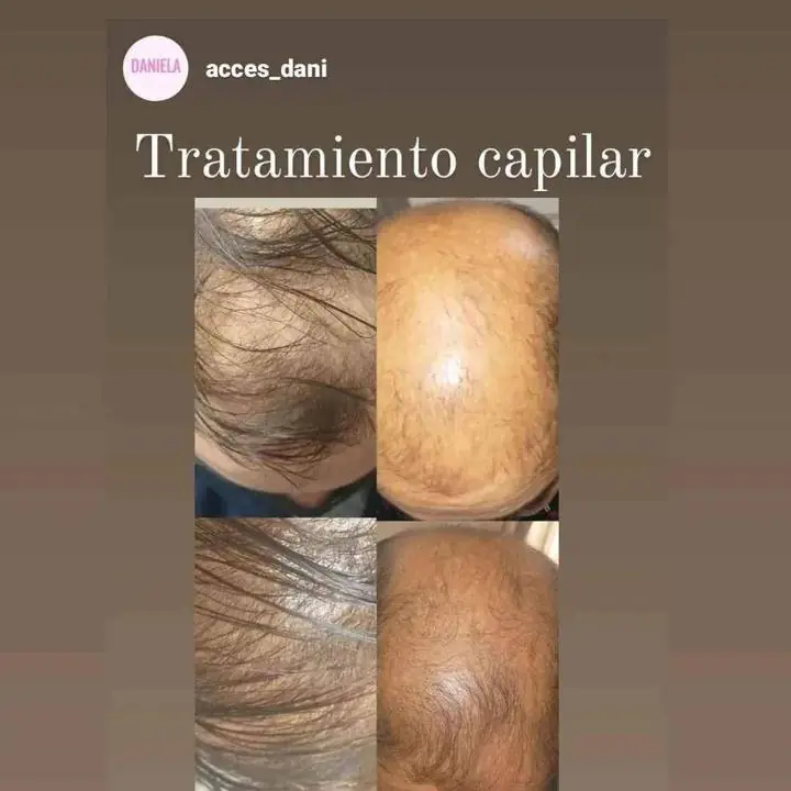 Todo para la caída del pelo